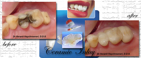 Ceramic/porcelain inlays&onlays:Phuket dental clinic,Thailand